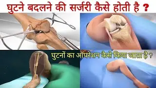घुटनों की सर्जरी कैसे की जाती है ? Knee replacement surgery in hindi