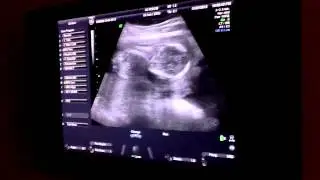 17 недель малышу.