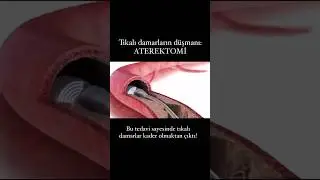 Tıkalı Damarların Düşmanı: Aterektomi