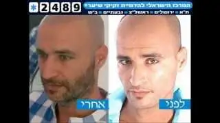 דמוי זיפים~ קעקועי שיער~ קעקוע קרקפת ~הדמייה מקצועית