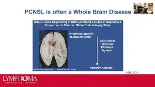 Primary Central Nervous System Lymphoma