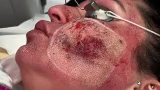 PROFRACTIONAL ERBIUM LASER HELPS BUILD COLLAGEN AND REMODEL DEEP SCARS ON THE CHEEKS | DR JASON EMER