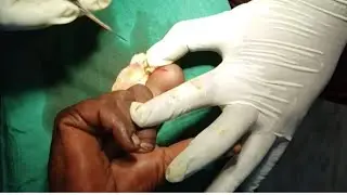 Infected implantation dermoid cyst of the finger