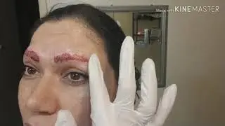 Laser tattoo removal one week down time