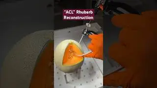 Here is an ACL Reconstruction with FiberTag TightRope