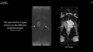 PET/CT F-18 Pylarify Case 8