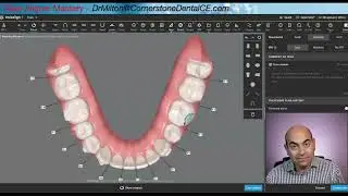 Clear Aligner Tip: Button Location Matters, too!