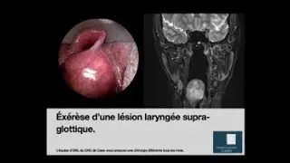 Exérèse d'une masse supra-glottique par voie endoscopique