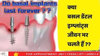 क्या बसल डेंटल इम्प्लांट्स जीवन भर चलते हैं DO basal Implants last forever ??#basalimplants#implants