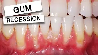 LOOSE TEETH From Gum Recession - TIGHTENED UP with The Pinhole Technique