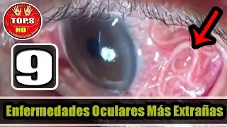 Top 9 Enfermedades Oculares Más Extrañas