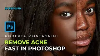 How to Remove Acne in Photoshop in fast simple steps