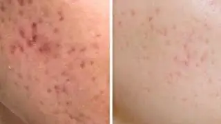 БЕЗЕУ, ПРЫЩИККЕ АРНАЛҒАН ҚОСПА👍БЕЗЕУДЕН ШАРШАДЫҢЫЗБА? ОНДА СОҢЫНА ДЕЙІН ҚАРАҢЫЗ 💯