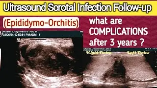 Chronic Scrotal Infection - Complications | Male Infertility | Epididymo Orchitis