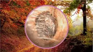 Giant Earwax Removal: Giant Piece of Earwax Removed from this Man's Ear. (2020) WATCH THIS!
