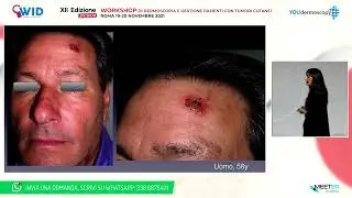 XII Workshop - E. Moscarella - Carcinoma squamocellulare: opzioni terapeutiche
