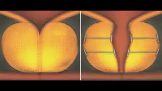 Urolift for prostate symptoms