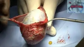 Radical orchidectomy