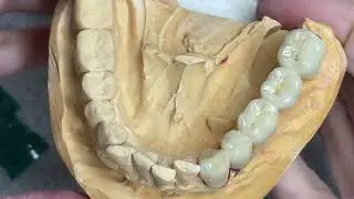 How to Make Lower Posterior Bridge 5 Unit Simple Buildup