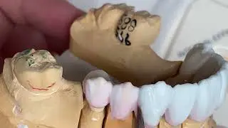 How to Make Zirconia Vita Porcelain 8 Unit Crown And Bridge Case