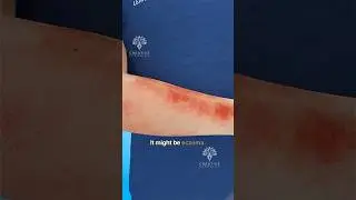 Why Does Eczema Happen 