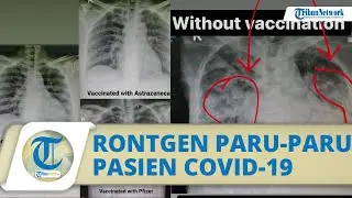 Viral Perbedaan Paru-paru Pasien Covid-19 yang Divaksin dan Tidak Vaksin