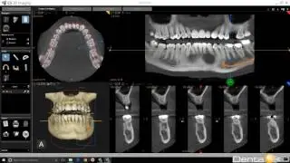 CS 3D Imaging - Tracé du canal mandibulaire