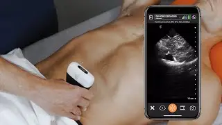 POCUS for Small Bowel Obstruction
