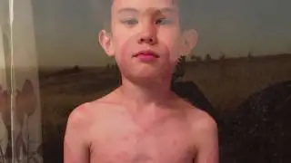 Boy Completely Healed from Lupus without Medicine
