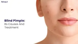 Blind Pimple: Its Causes And Treatment