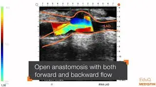 REQUEST Case 7: Graft patency verification with flow measurement and ultrasound imaging