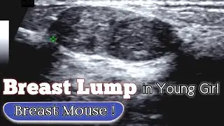 Ultrasound Young Girl Breast - Fibroadenomas | Breast Mouse