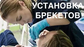 КАК СТАВЯТ БРЕКЕТЫ | Это не больно и недорого