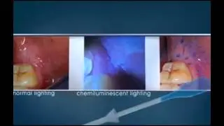 Oral Cancer - Miskin Ajax Dental