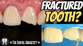 Quick Restoration of A Fractured Tooth 