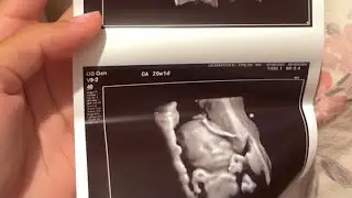 Is Chynaa Pregnant Fr??