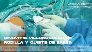 SINOVITIS VILLONODULAR DE RODILLA Y QUISTE DE BAKER