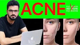 No More ACNE | Best Acne Treatment Available in Today Medical Science