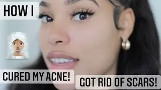 THIS COULD BE THE CURE TO YOUR ACNE AND SCARS!