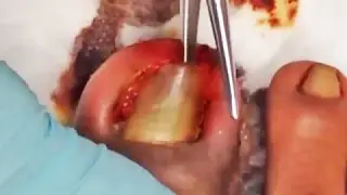 Worst Ingrown Toenail on YouTube?   Dallas Dermatology
