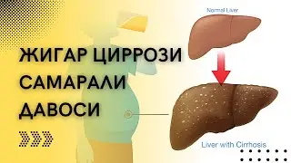Жигар циррози даволаш уй шароитида. 