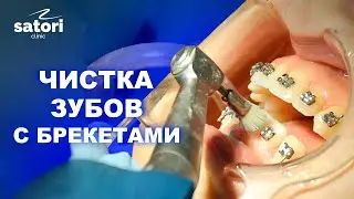 Brushing teeth with braces