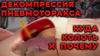 Пневмоторакс. Куда, как и почему вводить декомпрессионную иглу. 