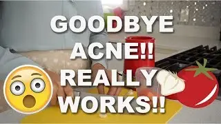 HOW TO GET RID OF ACNE! BEST HOME REMEDY FOR GETTING RID OF ACNE!!
