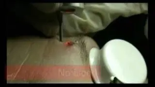 Dermatology - LASEmaR® 800 Selective Phototermolysis