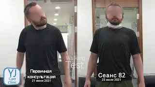 Спастическая кривошея / Пример лечения Дистония