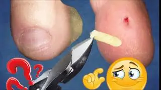Remove the callus. Deep callus. Pedicure. Removing corns on the legs. DEEP INVENTION