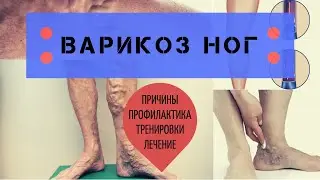 Стоп  Варикоз.  Введение