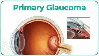 Primary Glaucoma 👁 : Ophthalmology Lecture