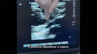 Acesso Venoso Central guiado por USG